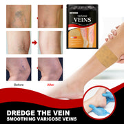 Foot Varicose Vein Relief Patch