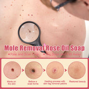 Cure Warts Remove Moles Face And Neck Filamentous Warts Body Cleaning Soap