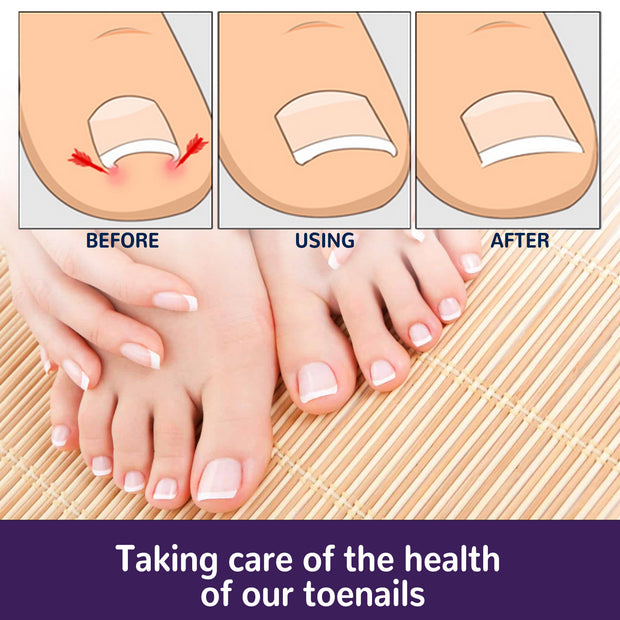 Home Fashion Elastic Toenail Correction Patch