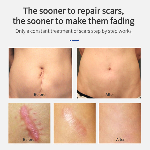 Scar Removing Cream Shark Hyperplasia Repair Gel